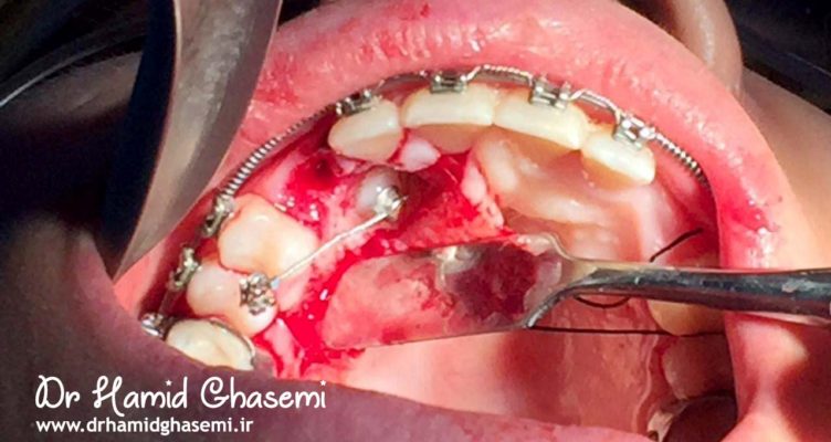 هدایت دندان نهفته به روش ارتودنسی