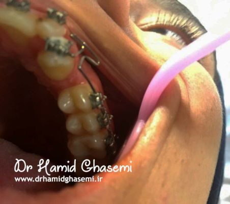 هدایت دندان نهفته به روش ارتودنسی