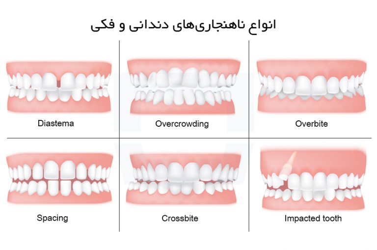 انواع ناهنجاری های دندانی و فکی