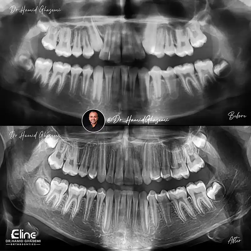 ارتودنسی لینگوال برای اصلاح ناهنجاری‌های دندانی