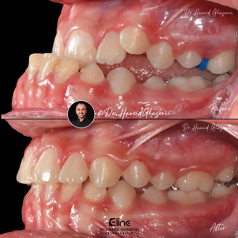 ارتودنسی بدون جراحی فک برای اصلاح ناهنجاری‌های فکی