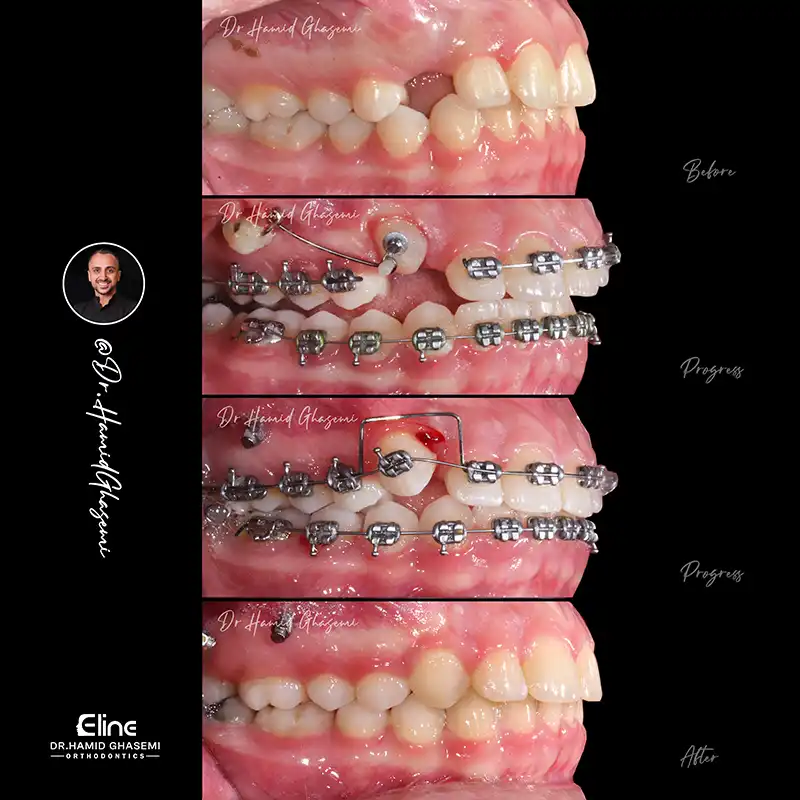 عوامل موثر بر هزینه ارتودنسی دندان