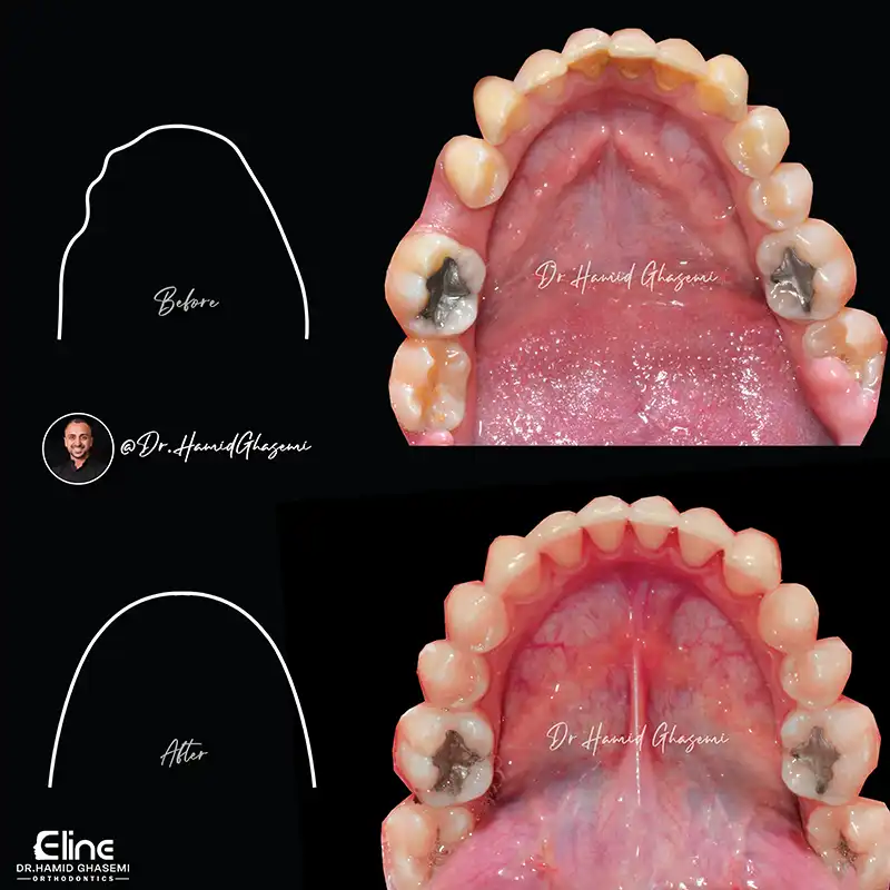 ارتودنسی متحرک برای اصلاح ناهنجاری‌های خفیف دندانی
