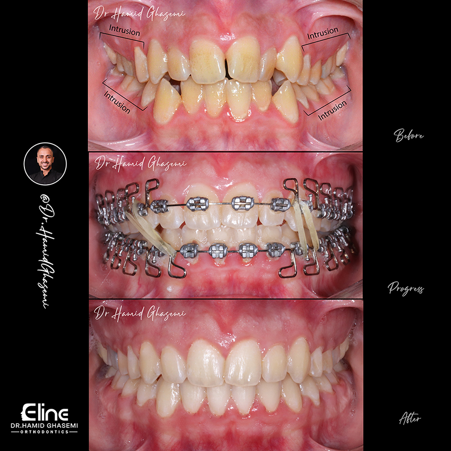 تکنیک MEAW در درمان تخصصی ارتودنسی