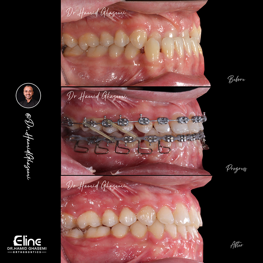 کاربرد روش MEAW در اصلاح بایت و ناهنجاری های دندانی