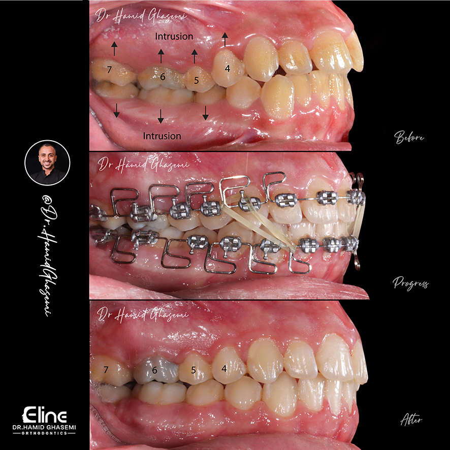 بررسی نتایج درمان ارتودنسی با روش MEAW