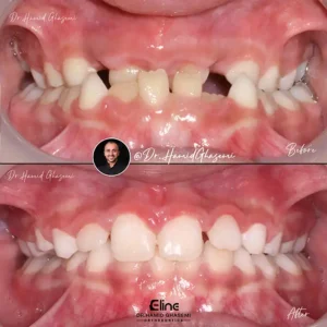 کاندید ارتودنسی بدون جراحی فک