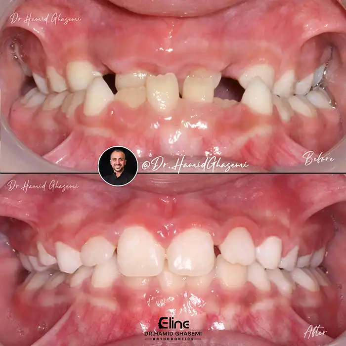 کاندید ارتودنسی بدون جراحی فک