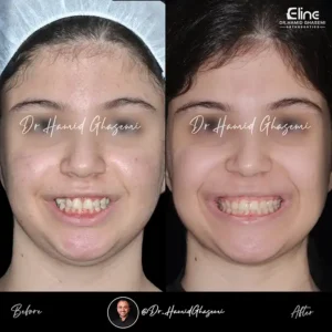 تفاوت ارتودنسی بدون جراحی فک و جراحی فک